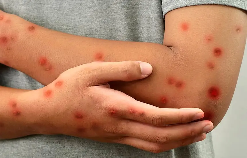 Alerta Global por la MPOX: Viruela Símica, conoce aquí todos los detalles