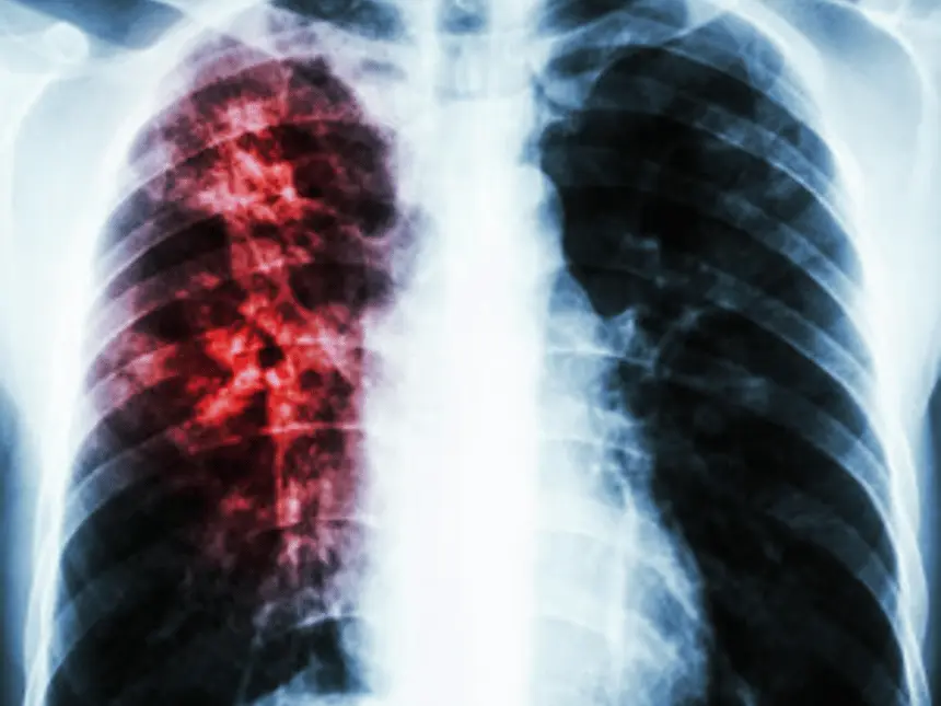 Pneumonia: Symptoms, Causes, and Treatment