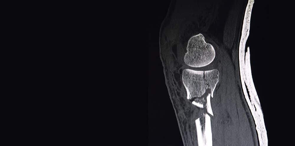 Мскт коленного. МСКТ коленного сустава с 3d визуализацией. Линейная томограмма коленного сустава.
