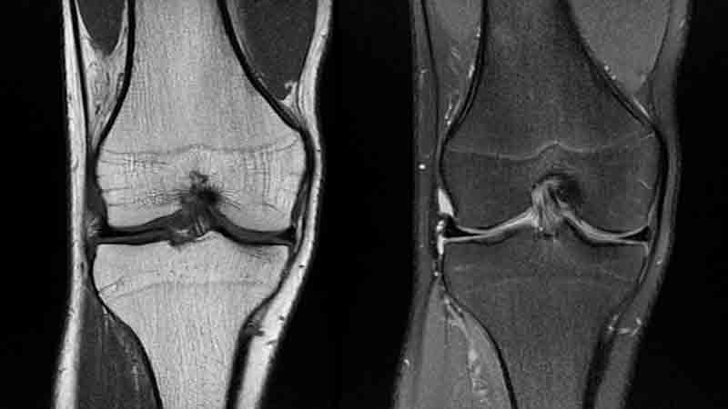 Resonancia magnética de rodilla, muscoesqueletico