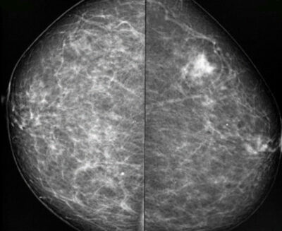 Cuídate: Lo que Debes Saber sobre Mamografía en Hospital CMQ