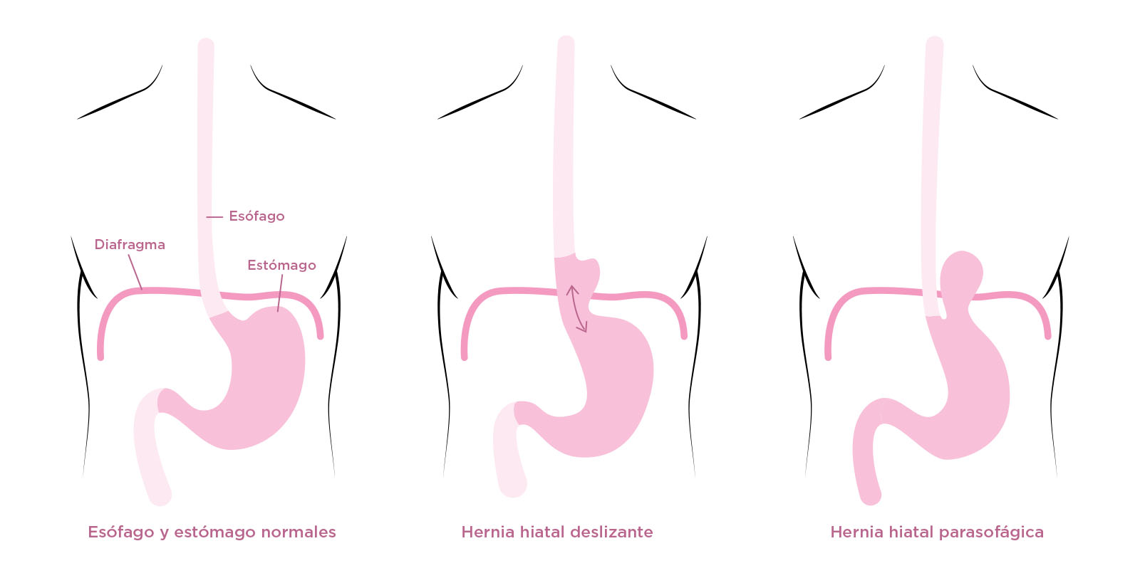 Tipos de Hernia Hiatal