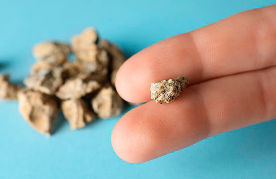 Piedras en el Riñón: Tratamiento y Cirugía en Hospital CMQ