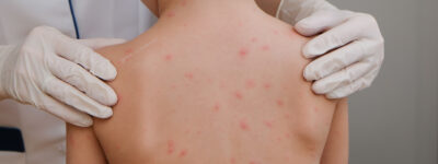 Sarampión en México: lo que necesitas saber